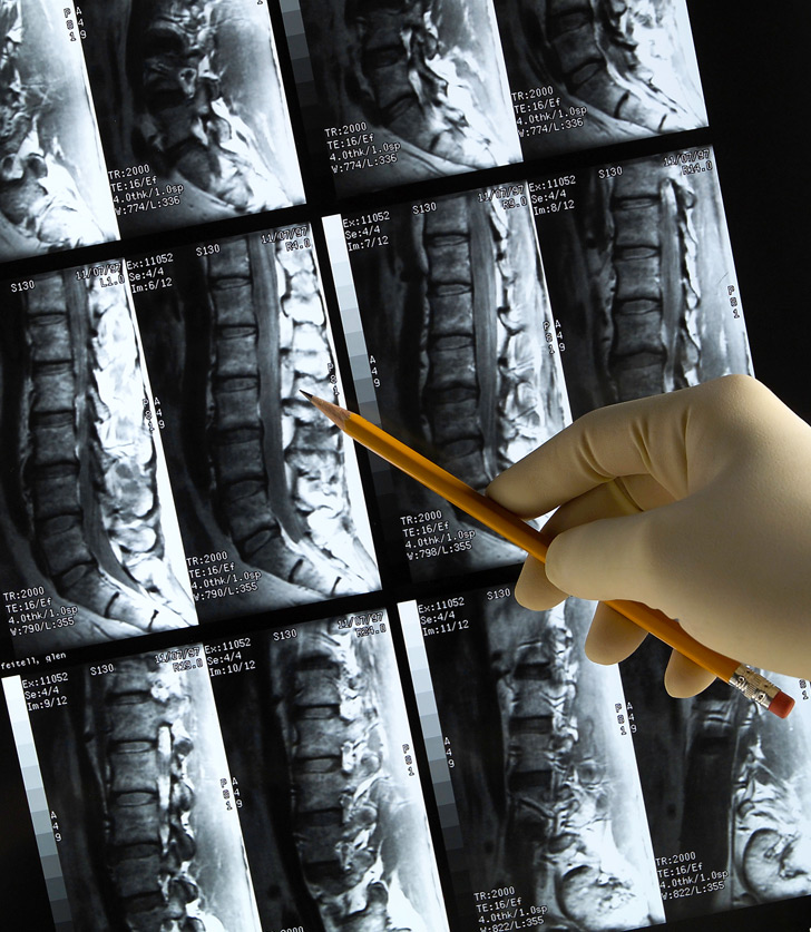 evaluating-spinal-cord-injury-Minaie-Law-Firm