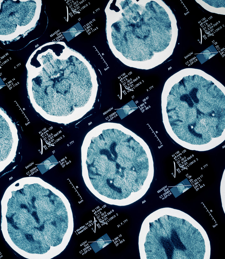 imaging-of-brain-injury-Minaie-Law-Firm